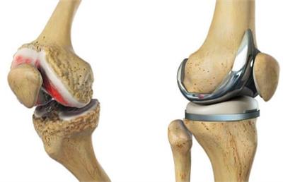 چه موقع به تعویض مفصل زانو نیاز پیدا میکنیم ؟