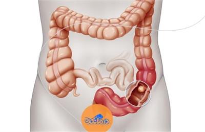 سرطان روده بزرگ یا Colon Cancer چیست؟