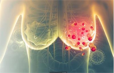 سن سرطان پستان در ایران جوان تر از دیگر نقاط جهان/ابتلا از ۴۵ سالگی