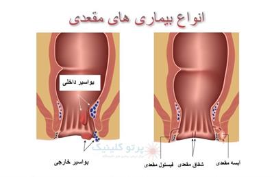 ۵ بیماری شایع مقعدی در زنان و مردان [پیشگیری با رعایت چند نکته ساده]